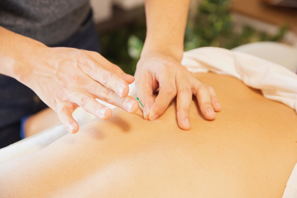 Acupuncture Treatment at Edge Health Barrie