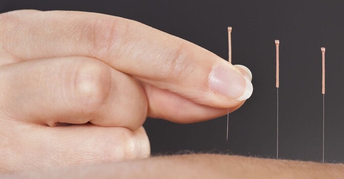 Acupuncture