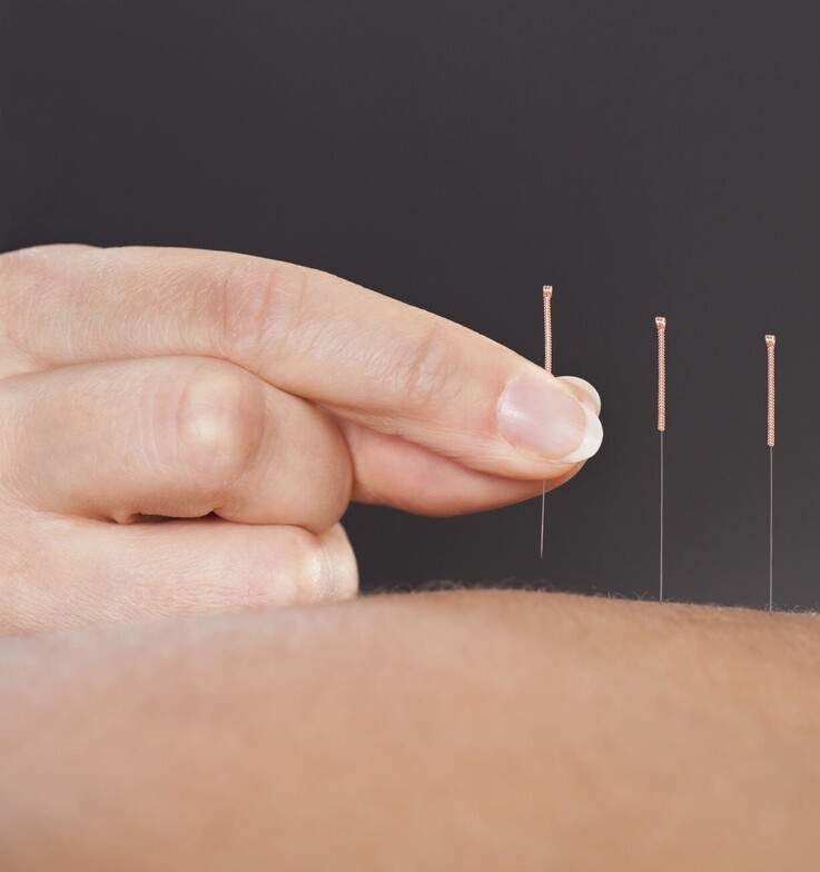 Acupuncture treatment at Edge Health Barrie
