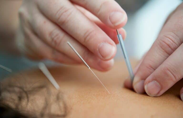 acupuncture barrie